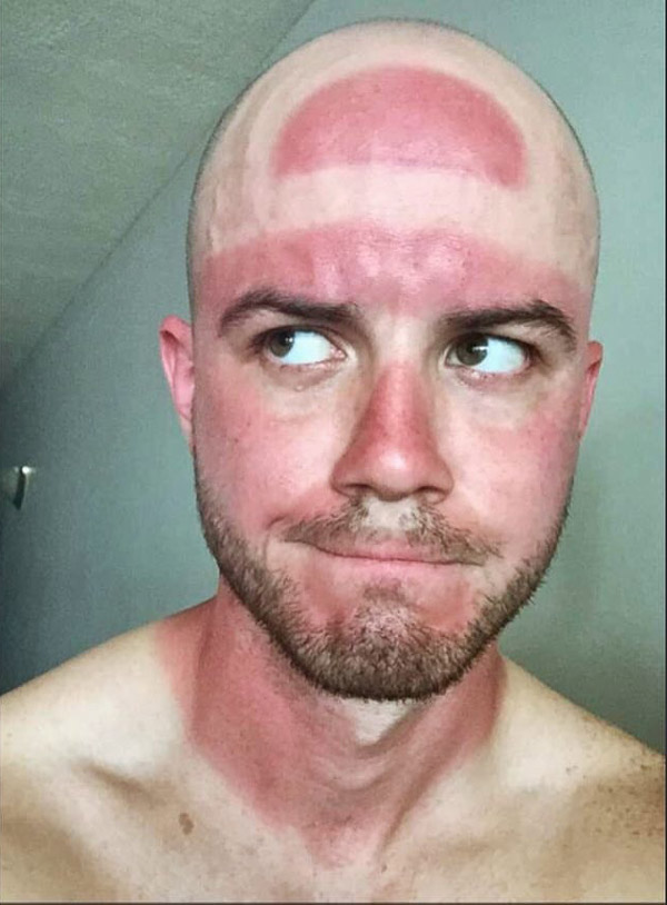 My friend went to the Cavs parade without sunscreen