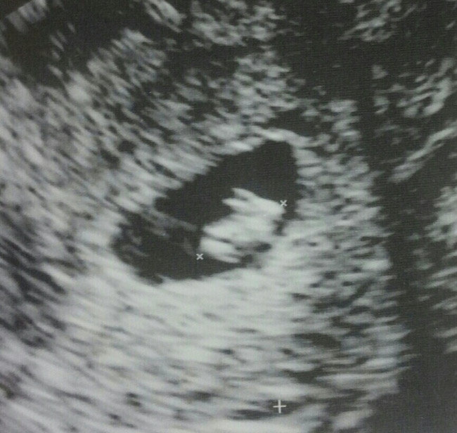 Went for my First Ultrasound Today... Turns Out I'm Having a Bunny