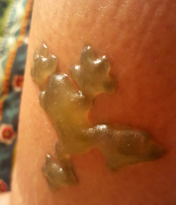 I got laser tattoo removal and woke up with this frog-shaped blister