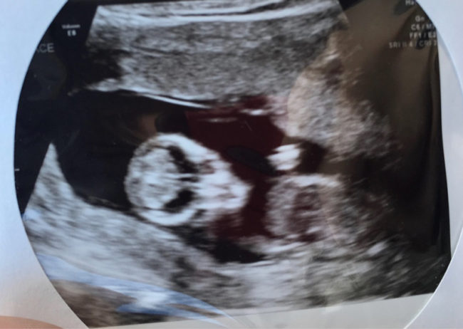 Wife had an ultrasound today. My baby looks like the Punisher
