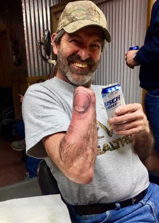 Man lost his hand but managed to keep one finger