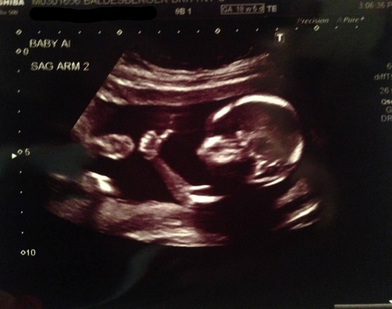 Recent ultrasound result looks good