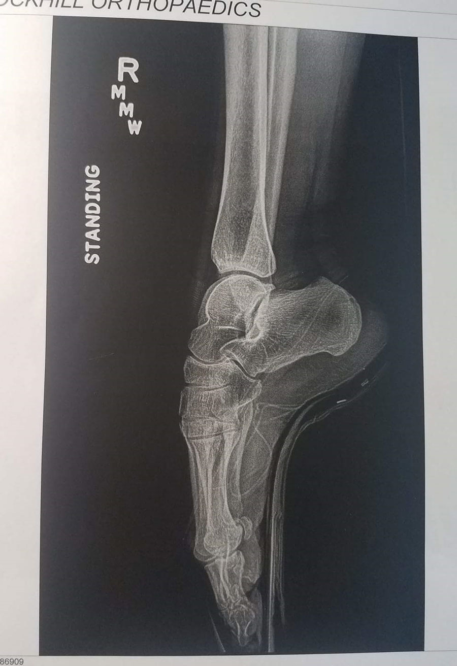 My wife's a ballerina, this is her xray while en pointe