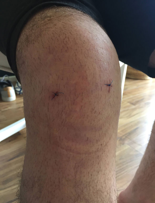 My boyfriend’s knee post surgery looks like a terrifying smiley face