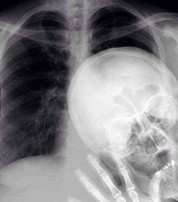 X-ray photo bomb