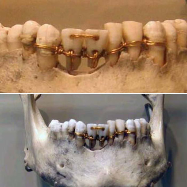 Ancient Egyptian dental work from 2000 BC
