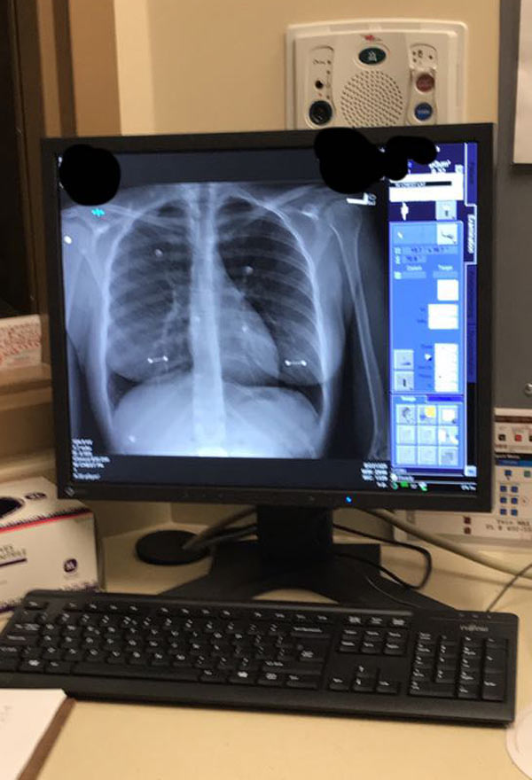 My girlfriend got an X-ray today and forgot to tell the doctor she had her nipples pierced