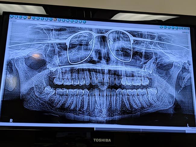 I got a panoramic x-ray of my teeth the other day. The dentist forgot to have me remove my glasses