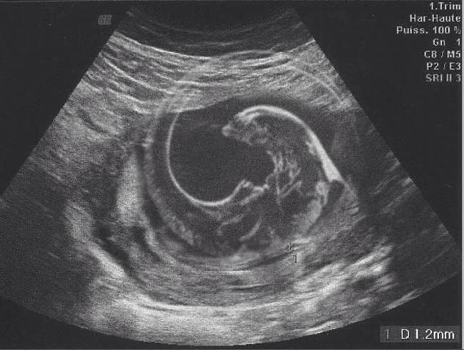 When my wife had an ultrasound for our first child, I took a photo of the print out so she could send to friends and family on WhatsApp. Instead I sent her this xenomorph image and she sent it to everyone before realizing what it was. She was not amused