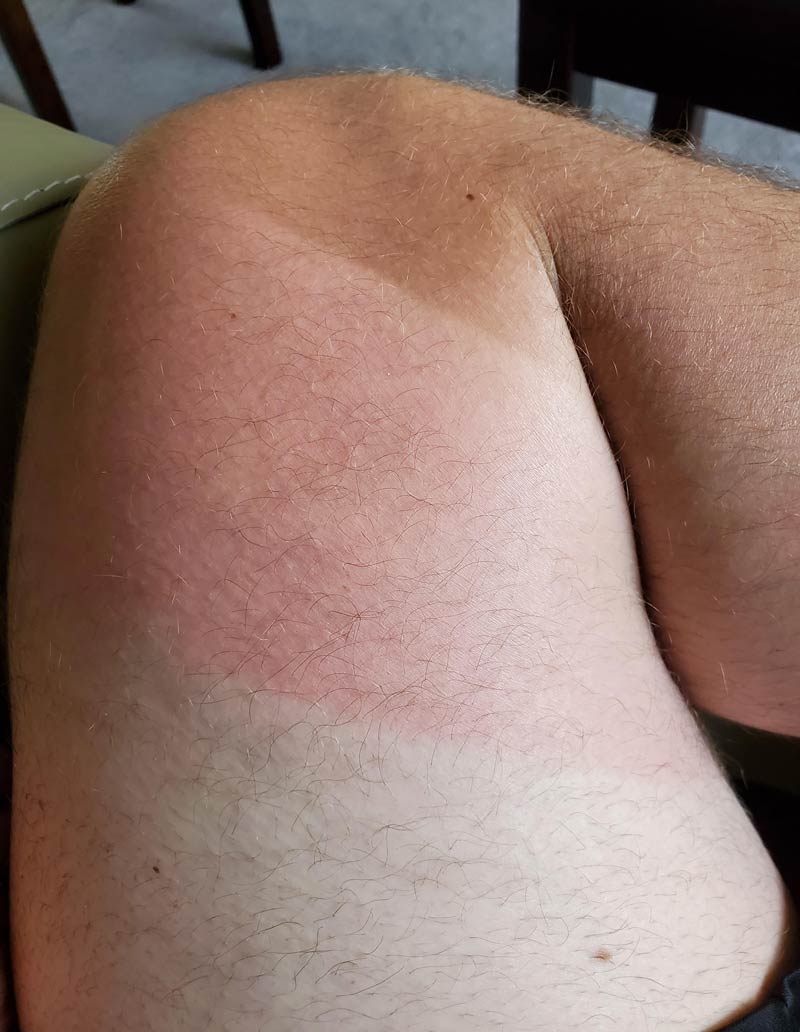 My sunburn looks like a tub of Neapolitan ice cream