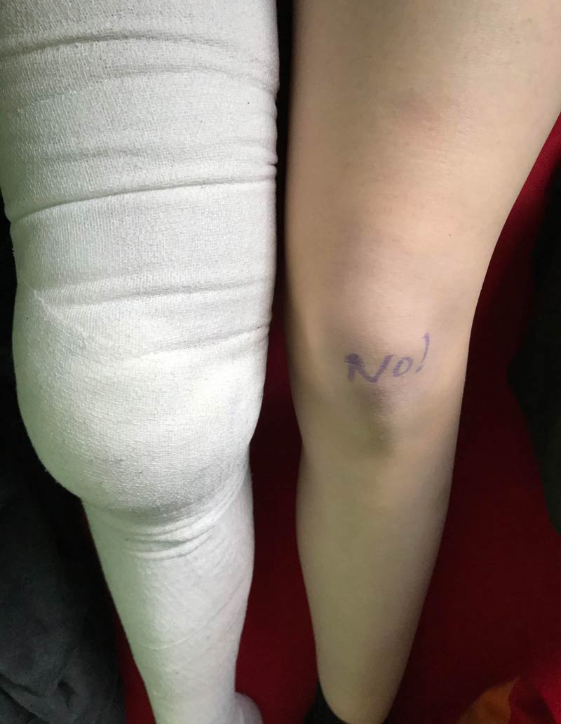 My surgeon marked the leg that he didn't want to operate on with “no!”