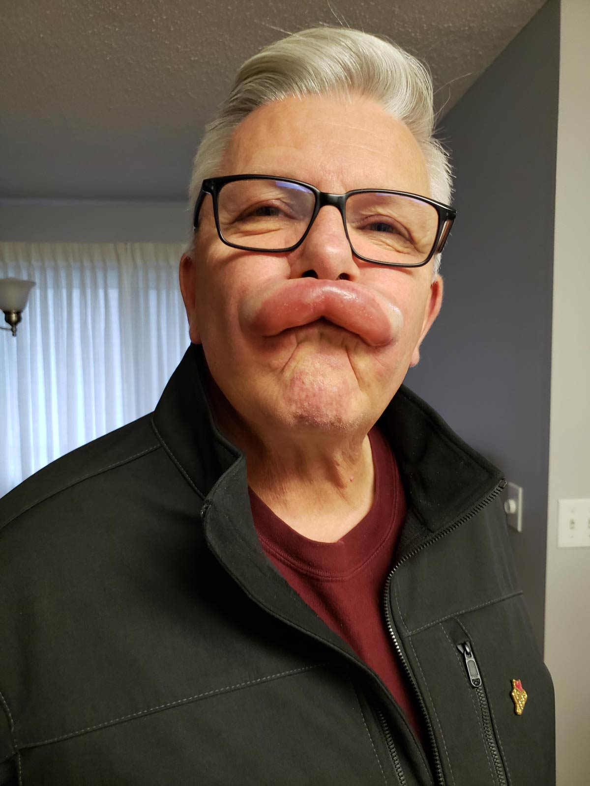 My dad had a small reaction after his root canal today
