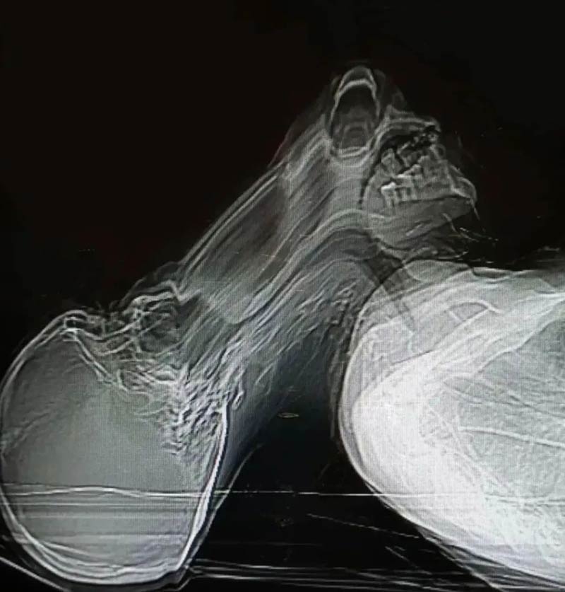 A patient experienced claustrophobia and moved during a CT scan