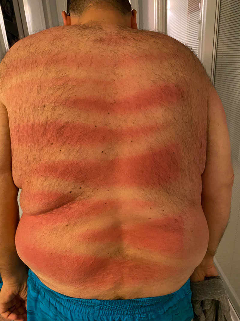 First day at the beach and my wife made sure I was protected from sunburn by spraying my back with sunscreen. I can’t see back there- did she do a good job?