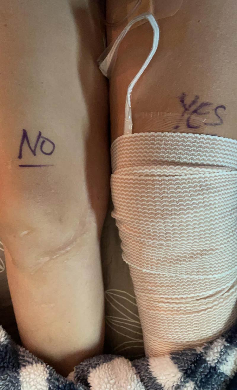 Had surgery today, the surgeon wrote reminders on my legs for which one to operate on