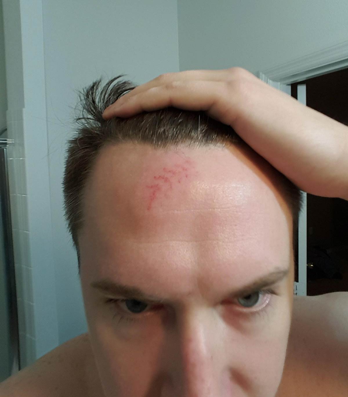 Joined a softball league, first game ever got hit in the forehead by the ball