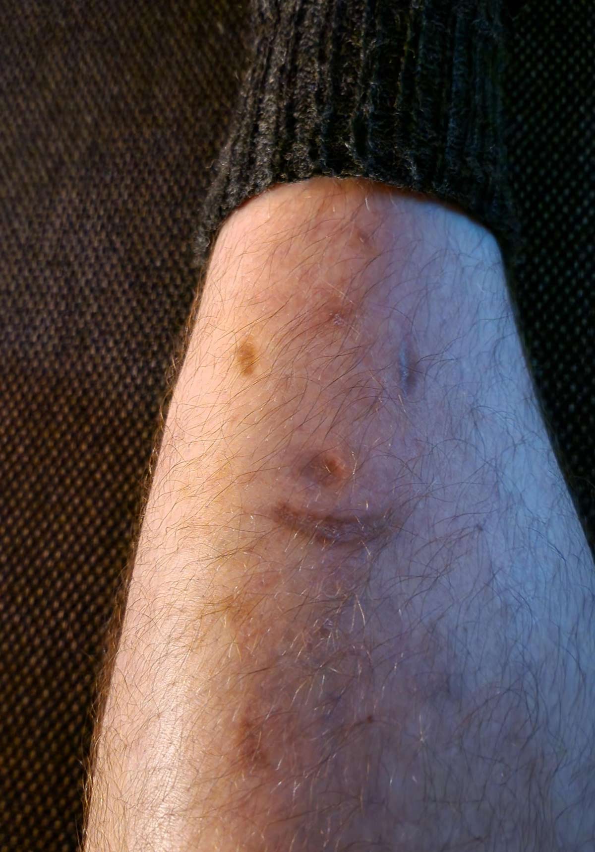 I have a scar smiley on my leg