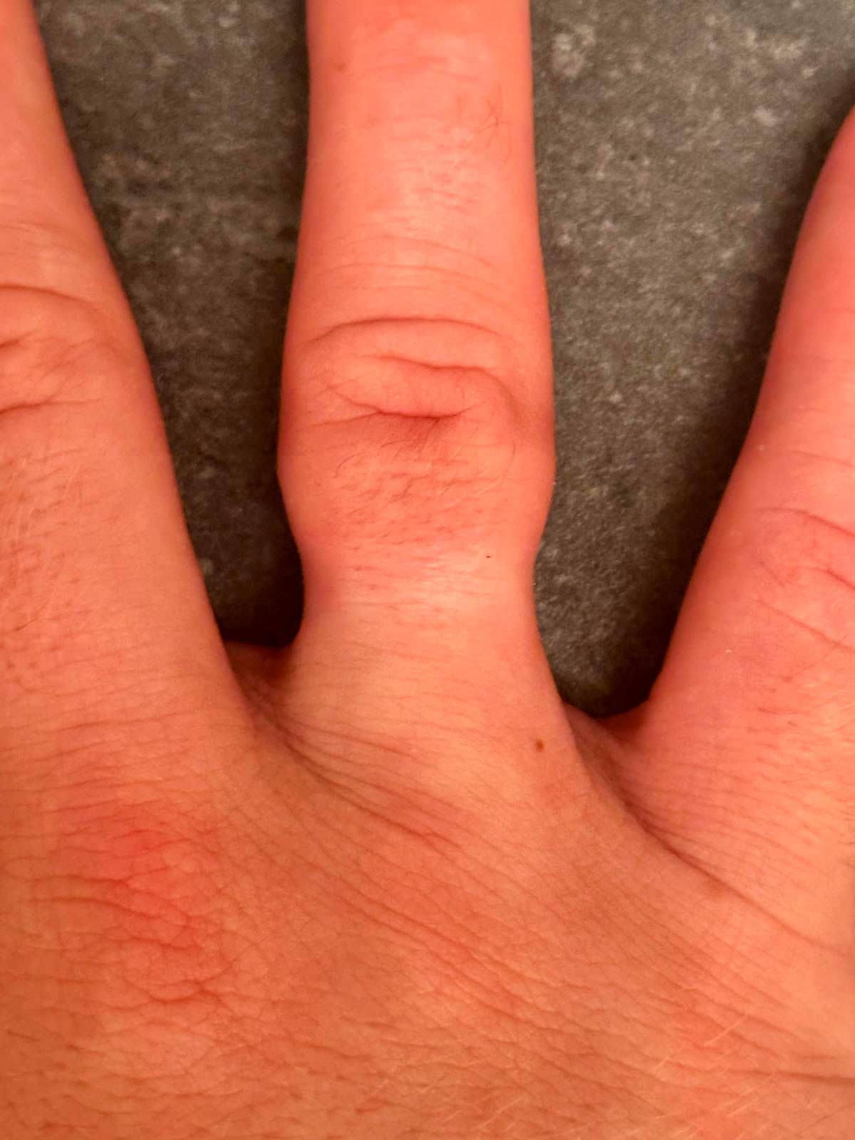 Hourglass finger after I finally got a ring off that’s been on for 2 1/2 years straight