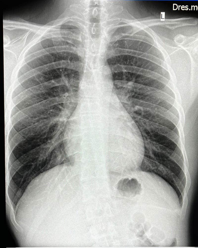 The black cloud is gas. This X-ray holds a picture of my, now visualized, fart