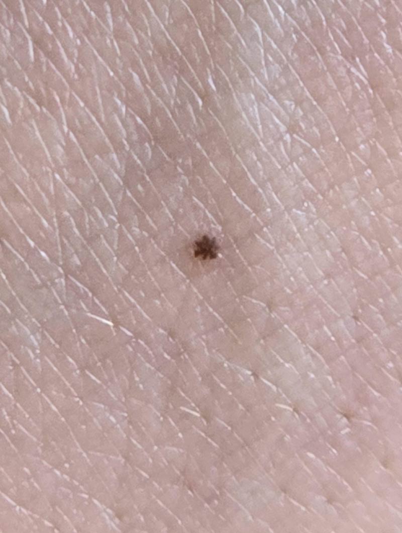 This tiny freckle on my hand looks like an asterisk