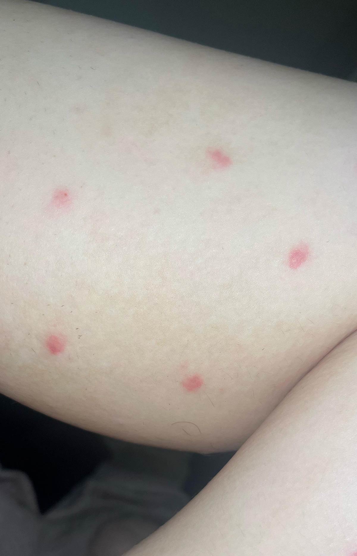 Mosquitoes created a perfect pentagram on my calf