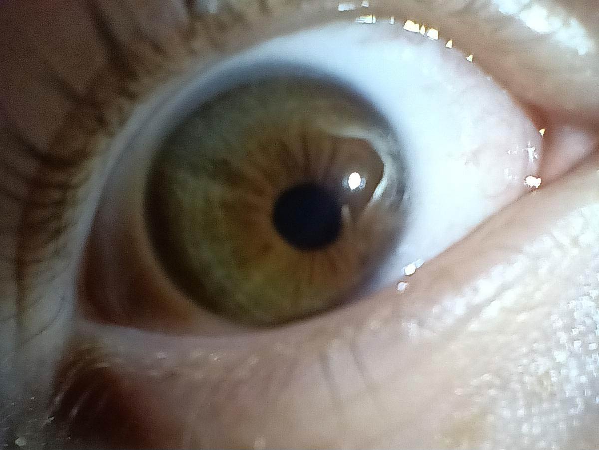 My pupils aren't in the middle of my eyes. Been like this since birth
